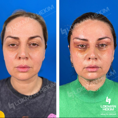Genioplastia Foto antes/después